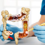 Cáncer de colon: “Estamos diagnosticando pacientes en estadios muy avanzados”