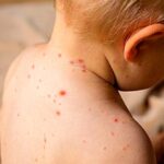 Sarampión: “Como provincia fronteriza, somos los primeros en estar en alerta”