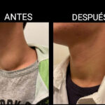 Día Mundial del Cáncer de Tiroides: prestar atención a los nódulos en el cuello